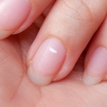 Photo for blog article titled Do your fingernails look like this? You may be deficient in zinc